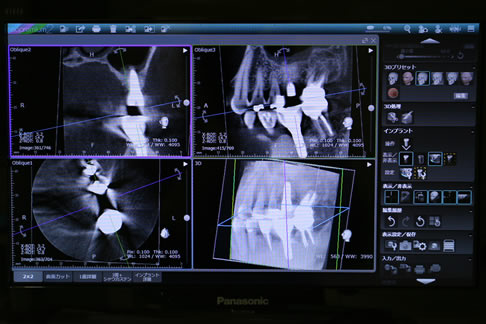 コンピュータ解析