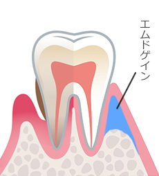 エムドゲイン法